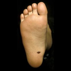 Example of moleRemoval